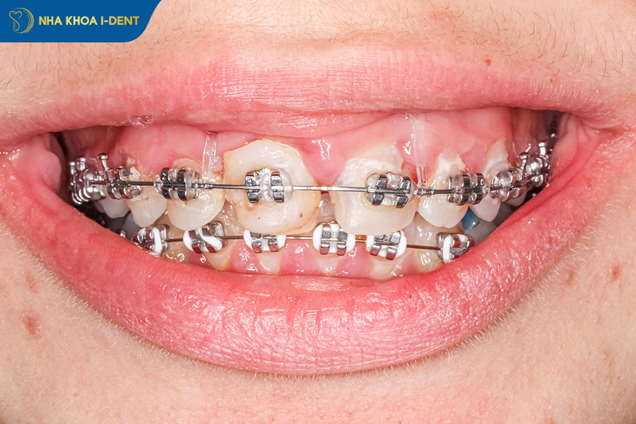 niềng răng hỏng bị nhiễm trùng nướu