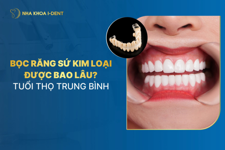bọc răng sứ kim loại được bao lâu
