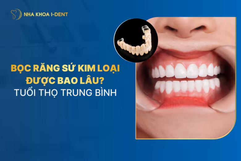 bọc răng sứ kim loại được bao lâu