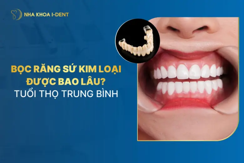 bọc răng sứ kim loại được bao lâu