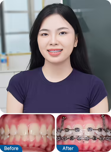 Common Cases For Orthodontics