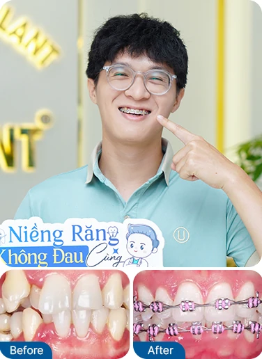 Common Cases For Orthodontics
