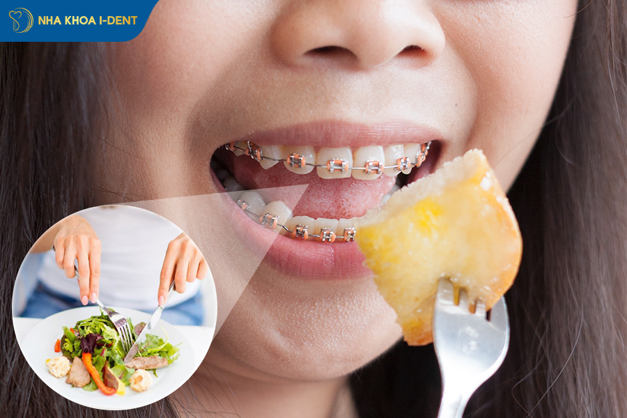 cách ăn sau khi niềng răng