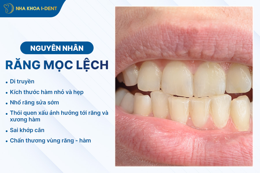 chỉnh răng mọc lệch không cần niềng