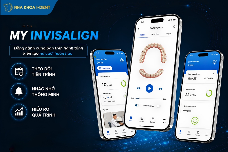 App theo dõi thông minh My Invisalign