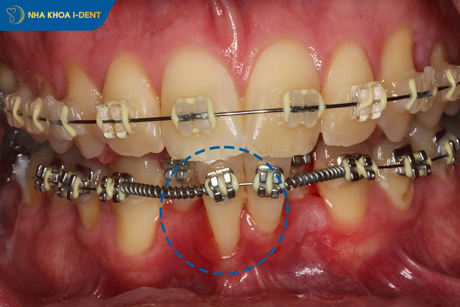niềng răng hỏng