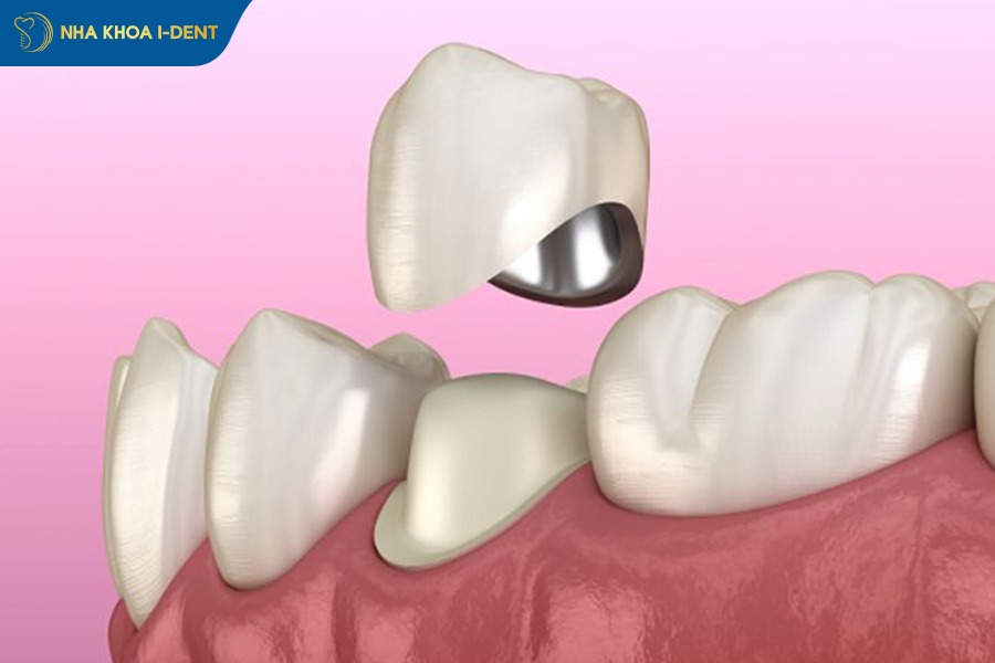 tooth crown price