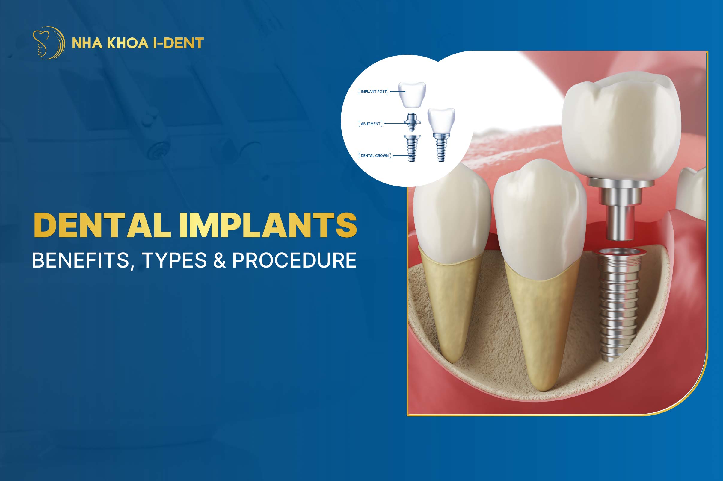 Dental Implants: Benefits, Types & Procedure