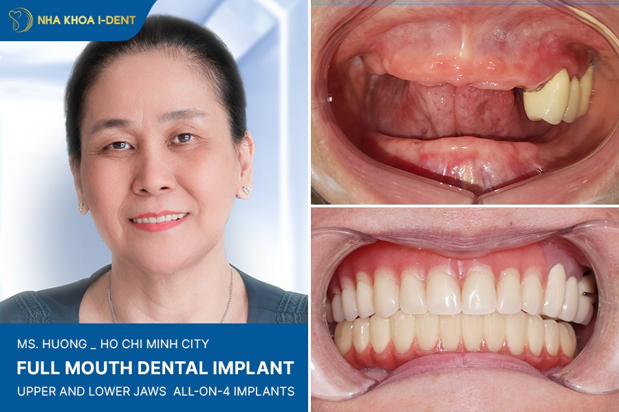 dental implants cost