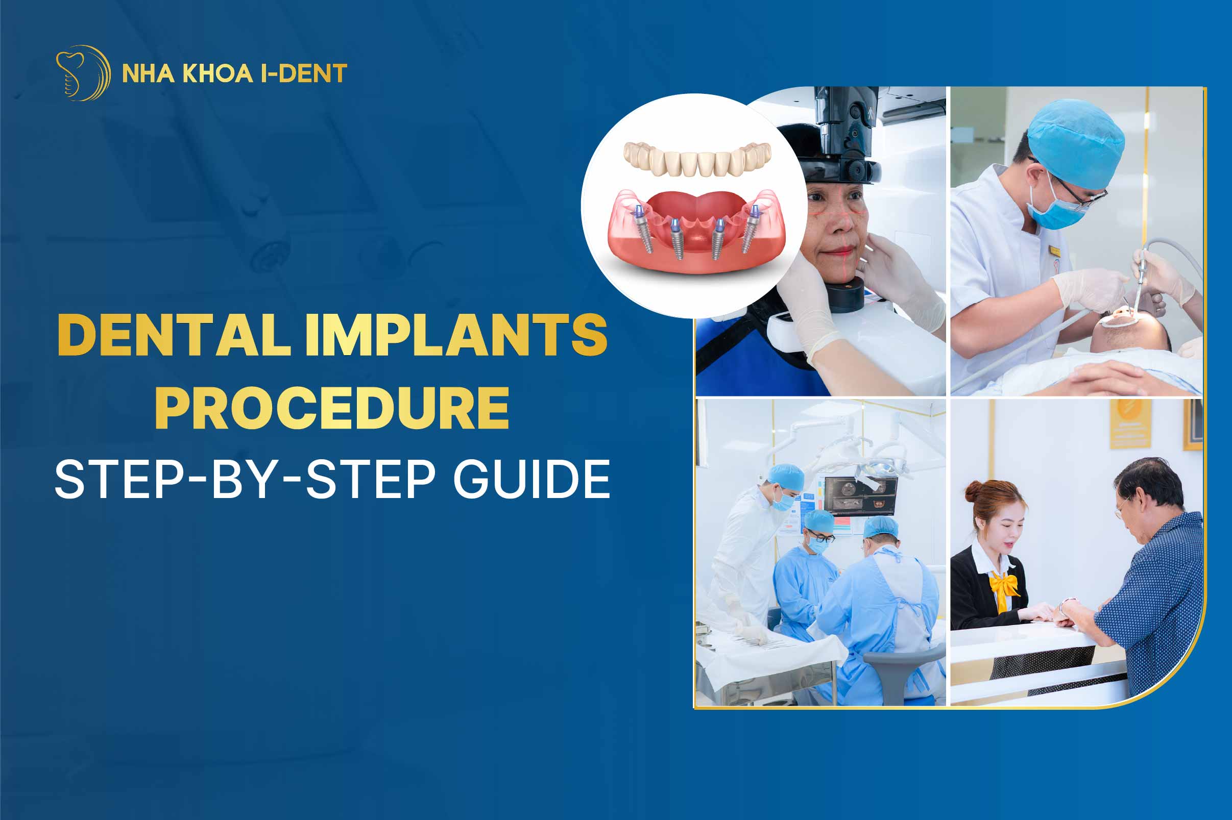 Dental Implants Procedure: Step-by-Step Guide