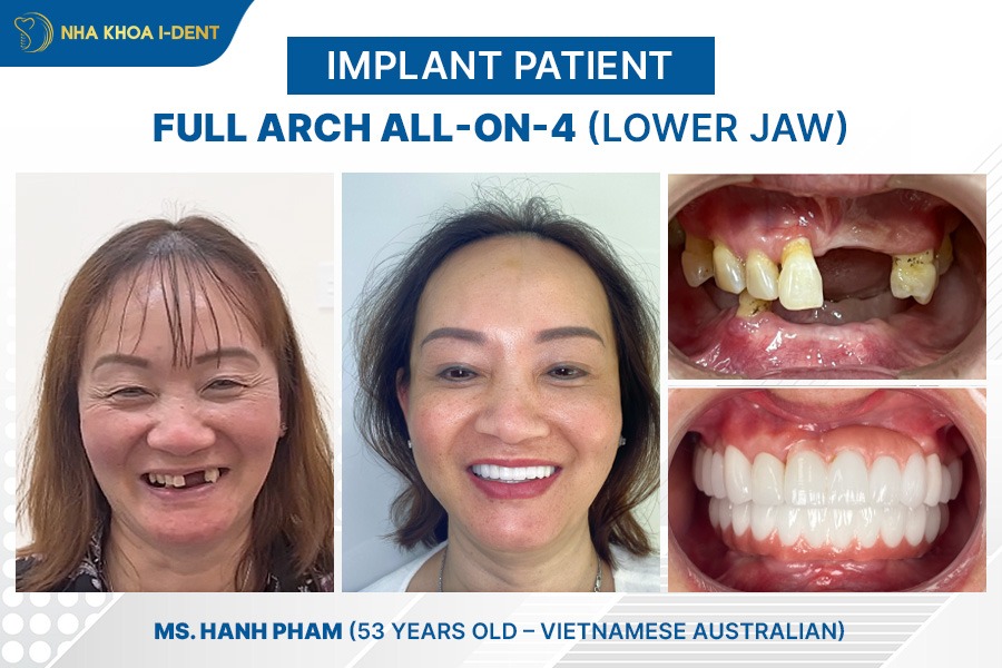 cost of dental implants