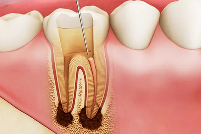 Điều Trị Tủy Răng