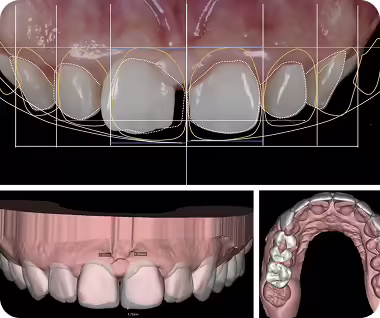 dental veneers