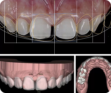 dental veneers