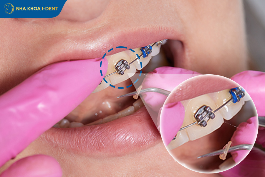 gắn mắc cài sai