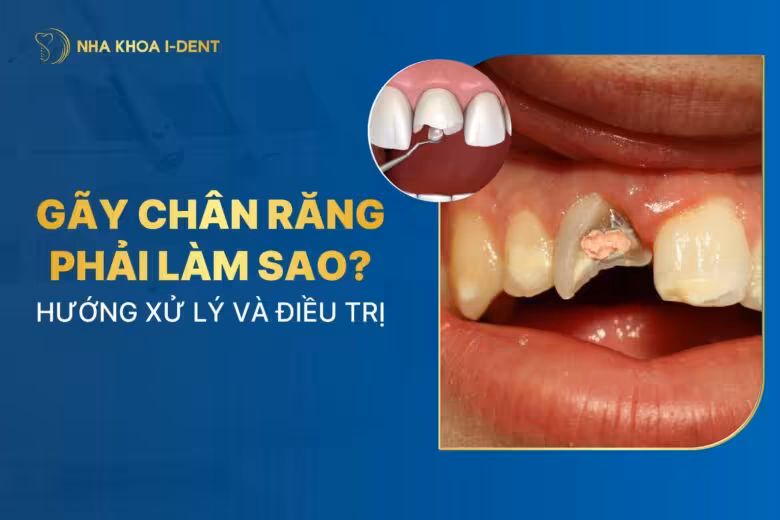 Gãy chân răng phải làm sao? Điều trị như thế nào?