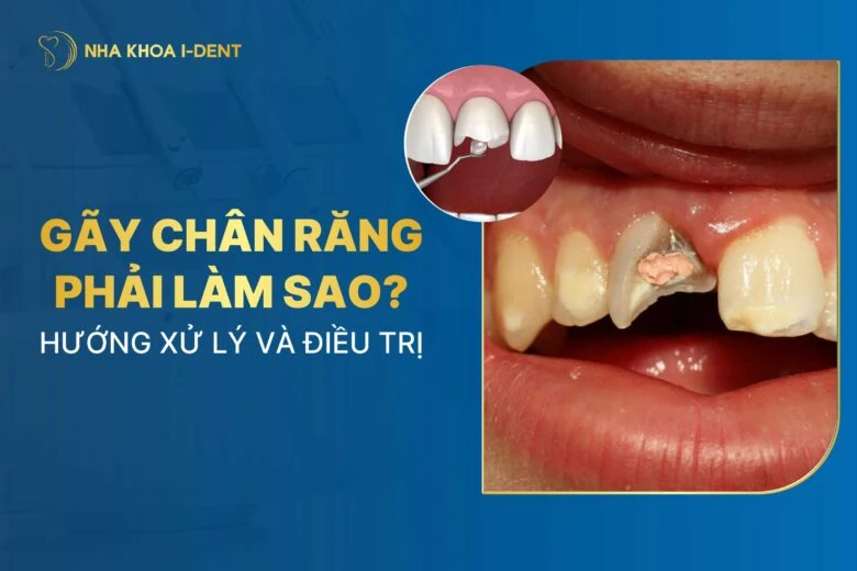 Gãy chân răng phải làm sao? Điều trị như thế nào?