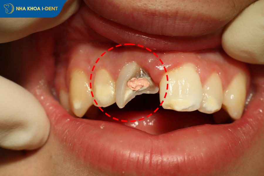 gãy chân răng phải làm sao