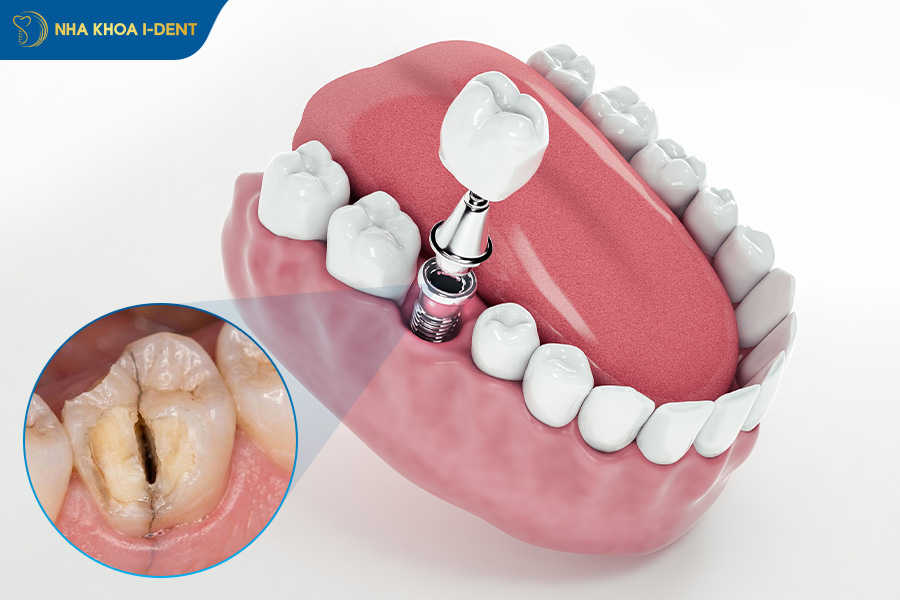 gãy chân răng theo chiều dọc
