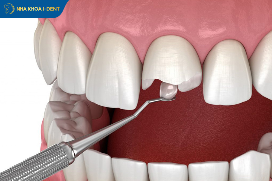 gãy chân răng theo chiều ngang