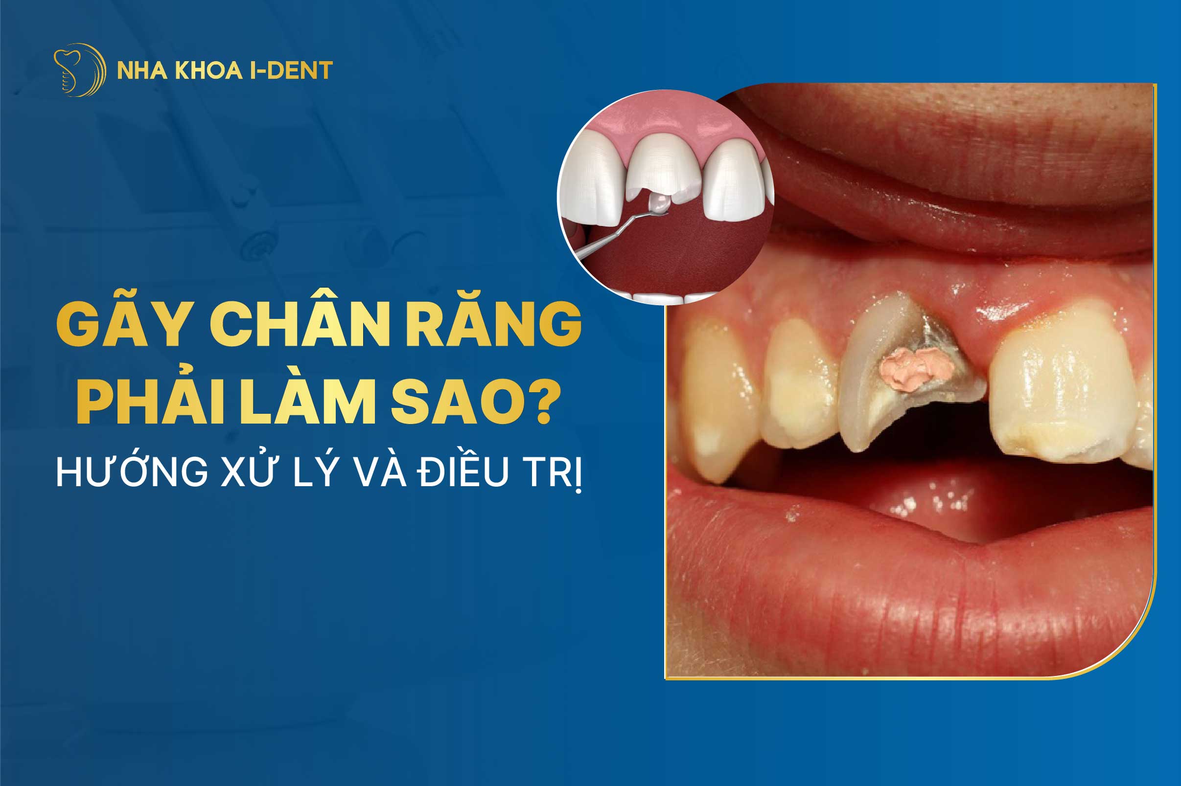 Gãy chân răng phải làm sao? Điều trị như thế nào?