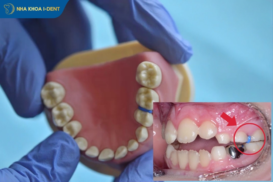 giai đoạn đau nhất của niềng răng khi nào