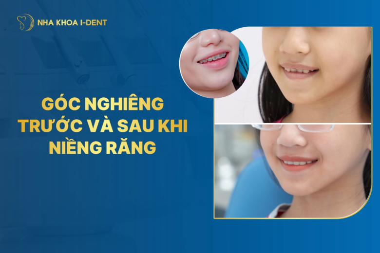 Góc nghiêng trước và sau khi niềng răng thay đổi như thế nào?