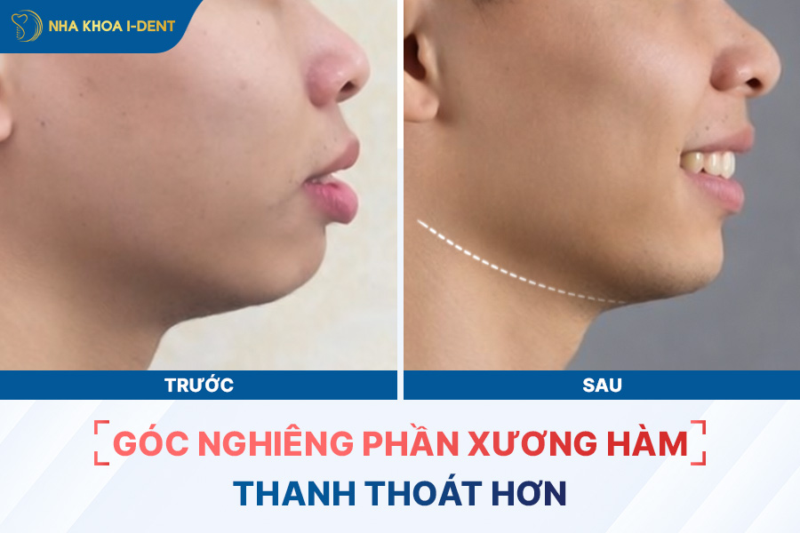 góc nghiêng trước và sau khi niềng