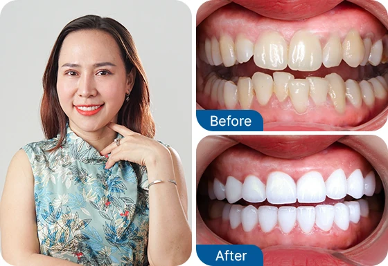 tooth crown