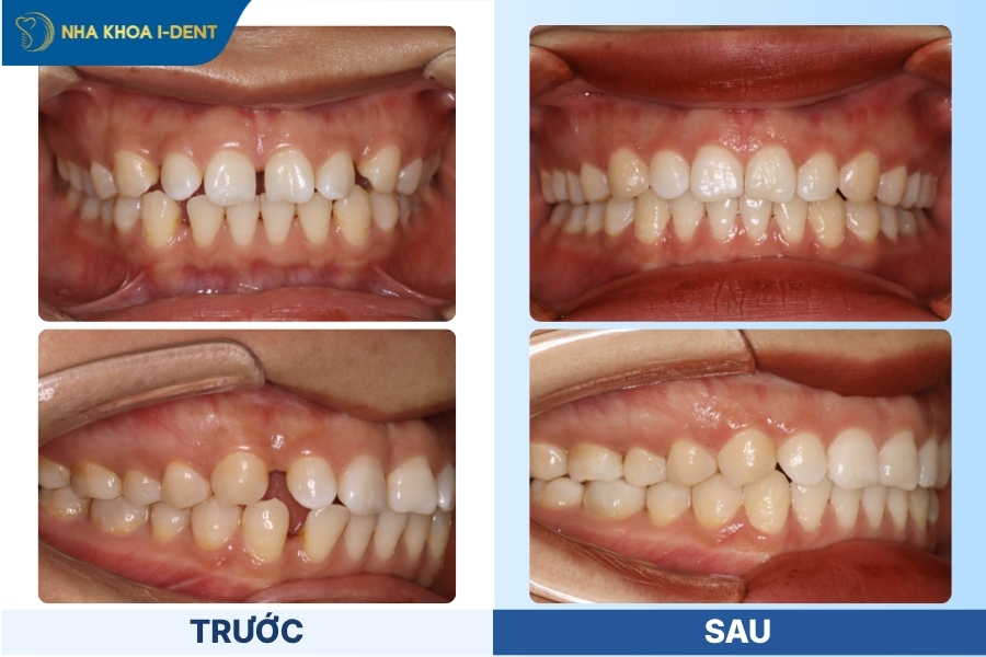 niềng răng khay trong suốt