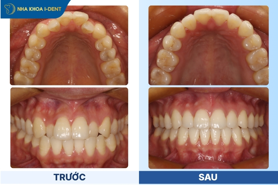 niềng răng bằng khay trong suốt