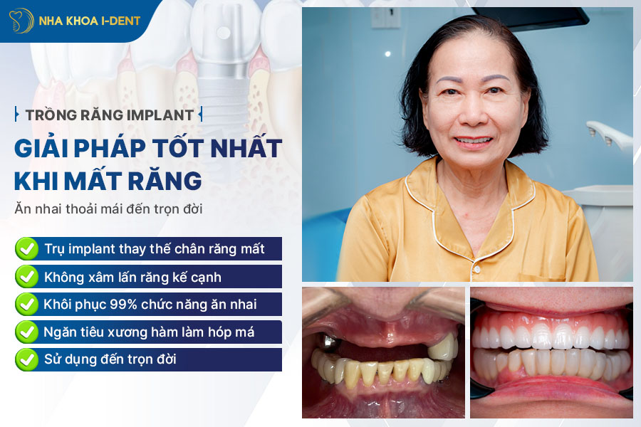 implant răng cửa - Nha khoa I-Dent