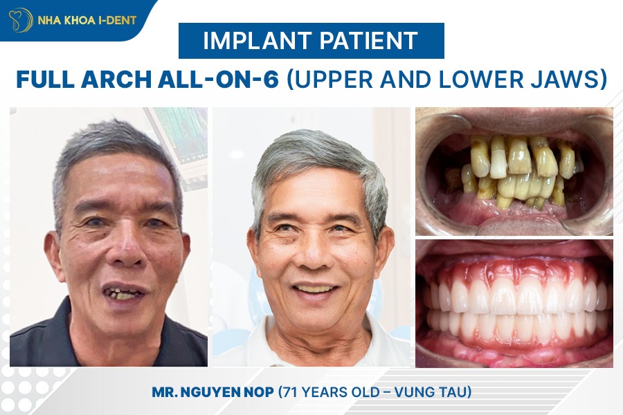tooth implant cost