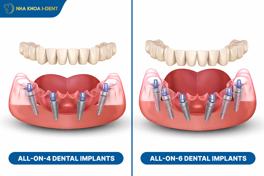 implant tooth