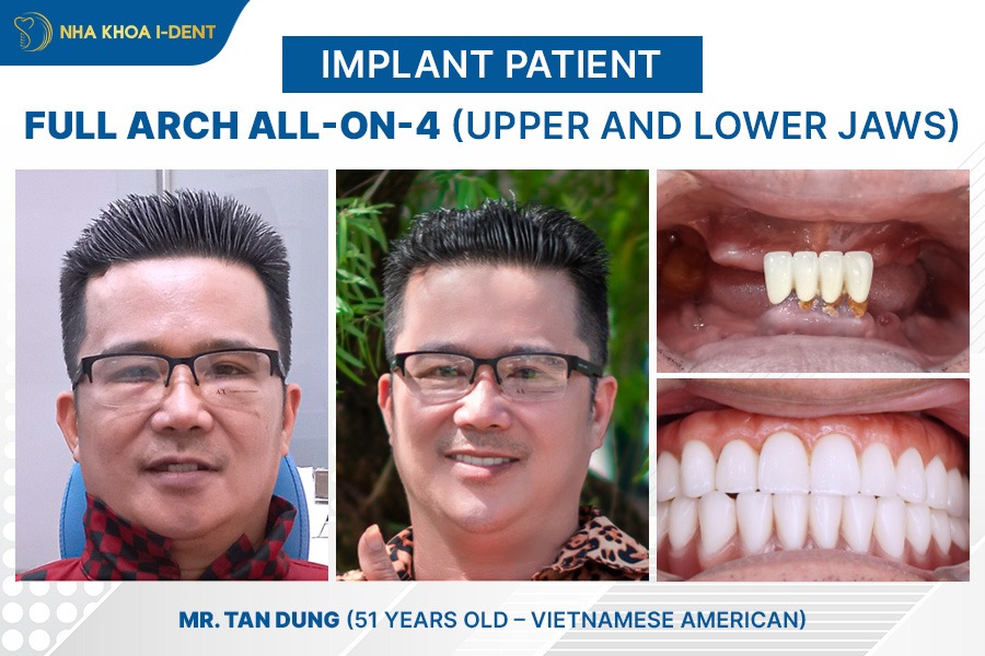 cost of dental implants