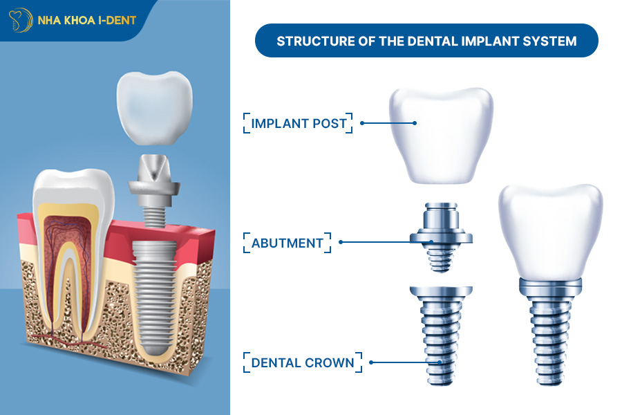 implants dental