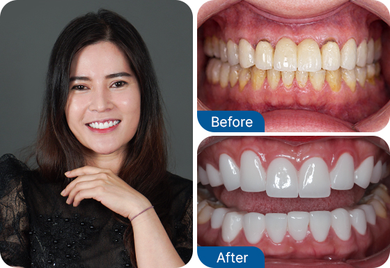 dental veneer