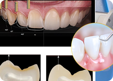Nha khoa I-Dent ứng dụng công nghệ Digital Smile Design để thiết kế dáng răng phù hợp với từng bệnh nhân.