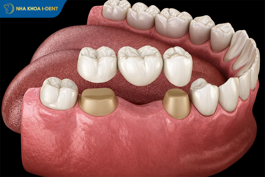 làm cầu răng sứ 2 răng số 6 hàm dưới