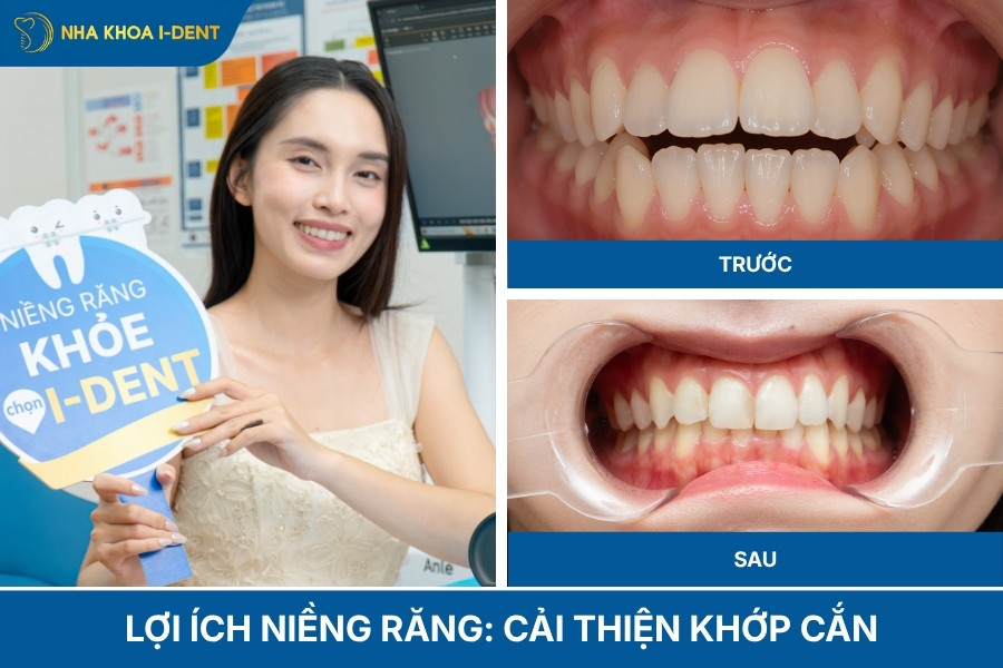lợi ích niềng răng