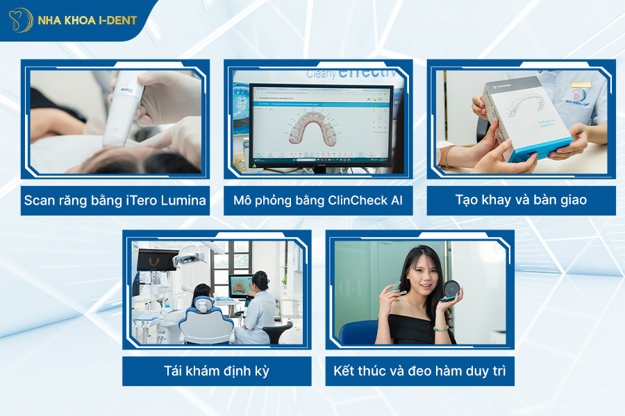 máng niềng răng trong suốt