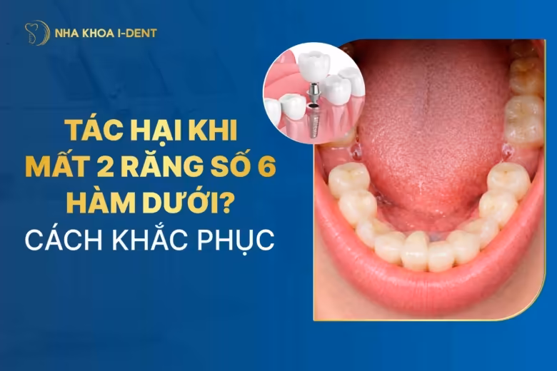 Tác hại khi mất 2 răng số 6 hàm dưới? Cách khắc phục