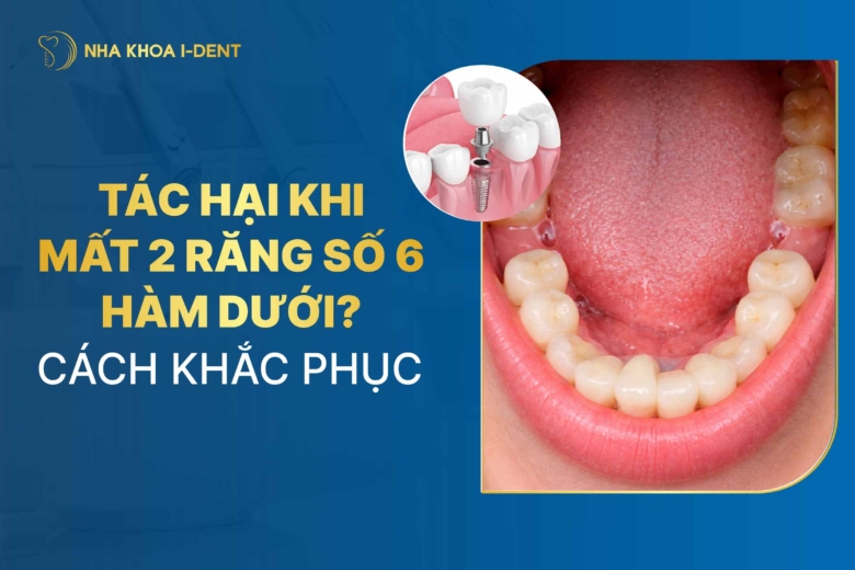 Hậu quả khi mất 2 răng số 6 hàm dưới? Cách khắc phục