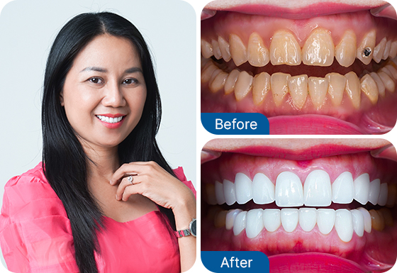 tooth veneers
