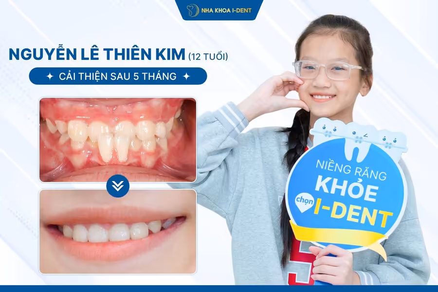 Bé Thiên Kim điều trị niềng răng tại Nha khoa I-Dent
