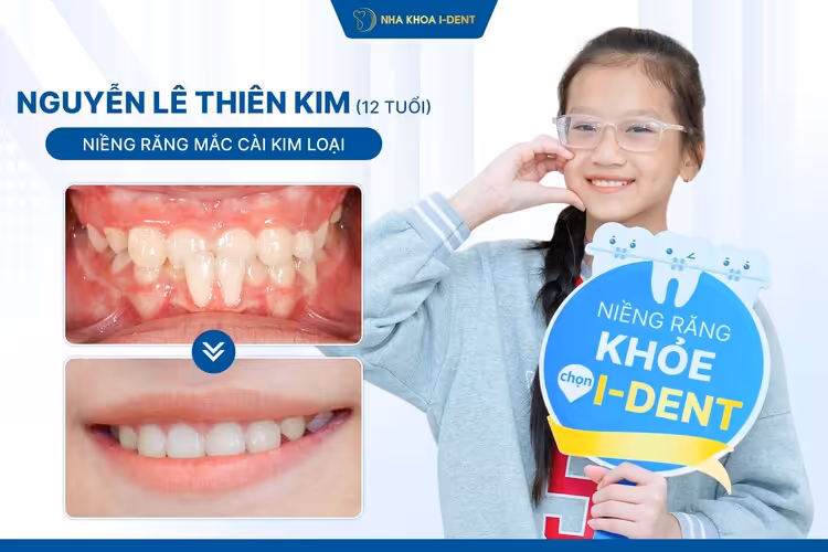 bé Thiên Kim niềng răng mắc cài