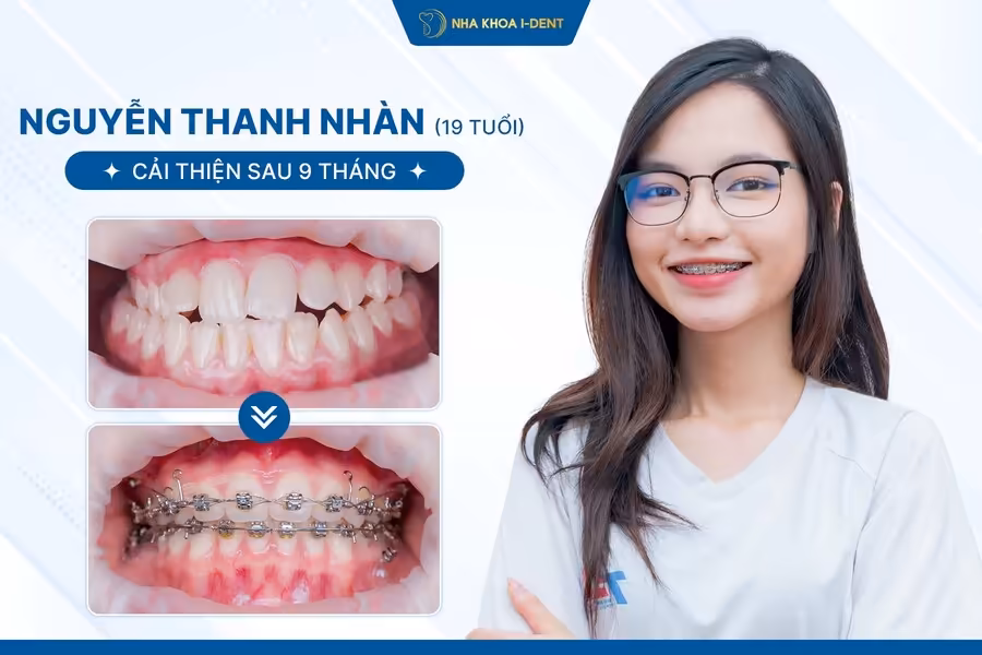 Niềng răng mắc cài kim loại của Nguyễn Thanh Nhàn