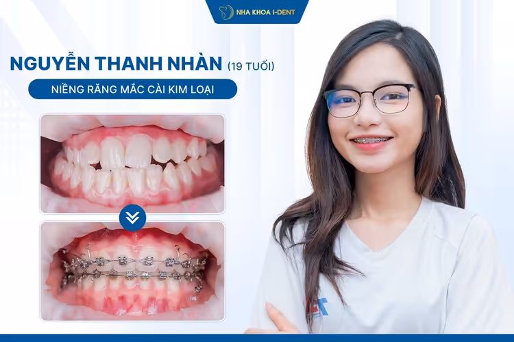 Hành Trình Niềng Răng Của Thanh Nhàn: Tự Tin Bước Vào Ngưỡng Cửa Đại Học