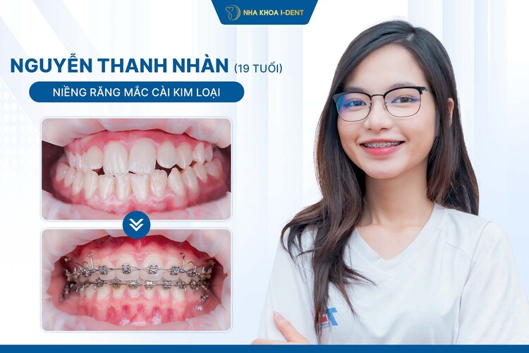 HÀNH TRÌNH NIỀNG RĂNG CỦA KHÁCH HÀNG THANH NHÀN: TỰ TIN BƯỚC VÀO NGƯỠNG CỬA ĐẠI HỌC