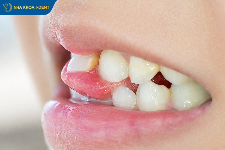 những cách nhổ răng tại nhà